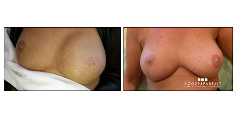 Aréole mammaire reconstituée par dermographie au Centre de soins dermato-esthétiques A Corps Parfait à Erpent